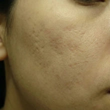 Testimonio Scar Solutions barra de silicona